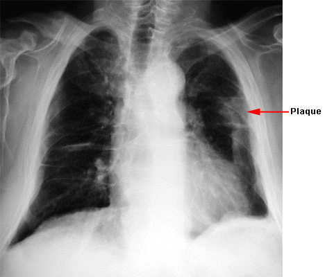 Asbestose (image Dr V. Latrabe. Service d'imagerie - Hôpital du Haut-Lévêque - Bordeaux )