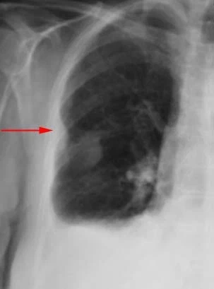 Mésothéliome (image Dr V. Latrabe. Service d'imagerie - Hôpital du Haut-Lévêque - Bordeaux)