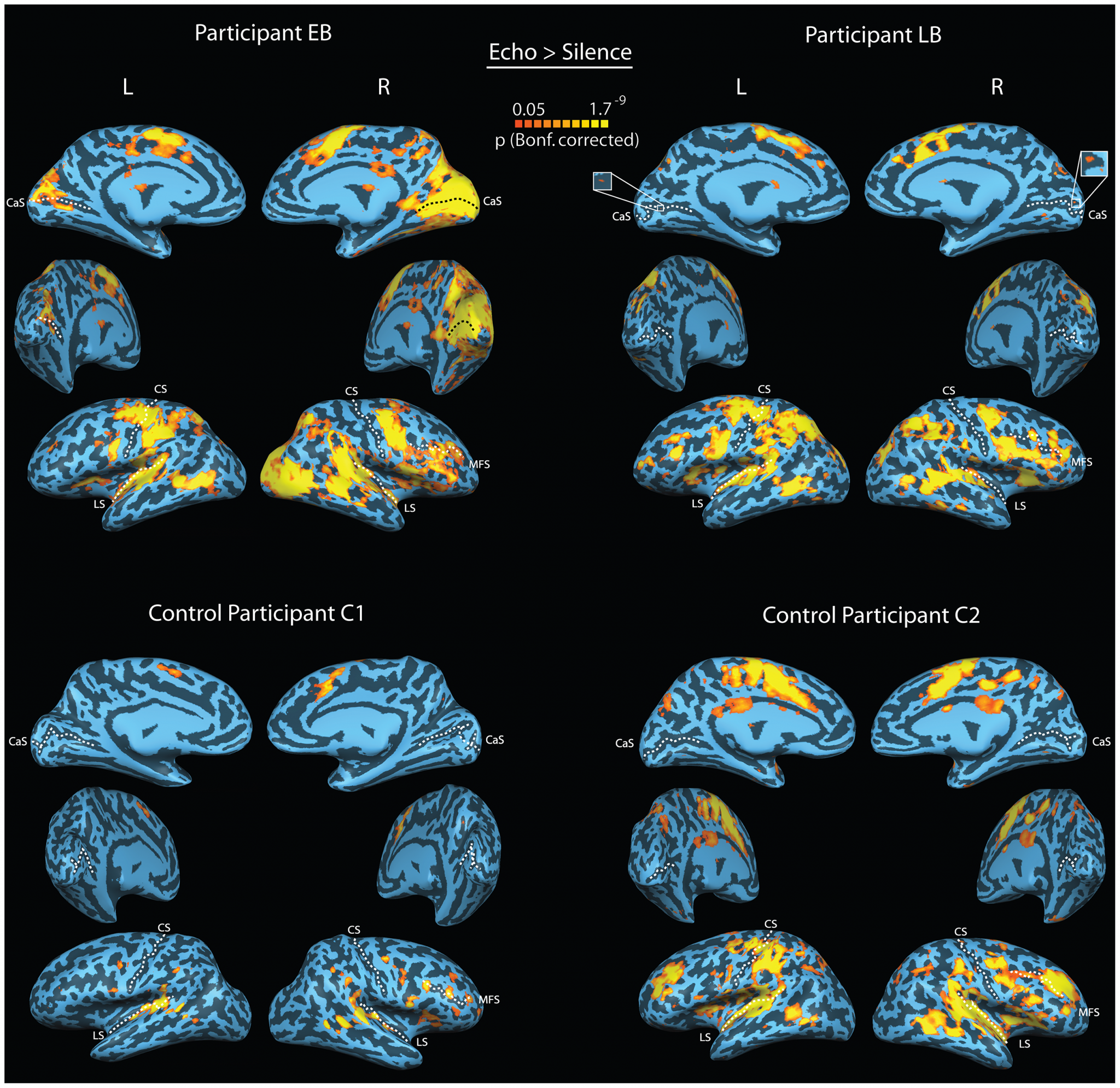 image de l'activité cérébrale de Kish (EB)